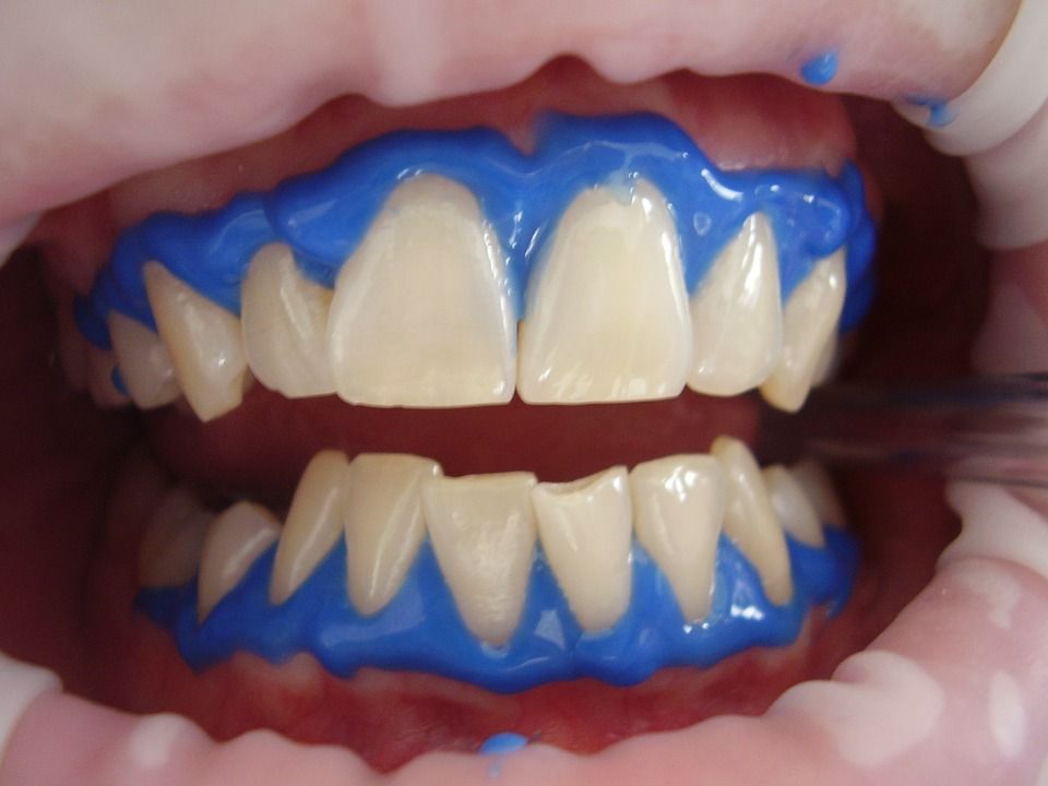 This is what your patients should know about teeth whitening